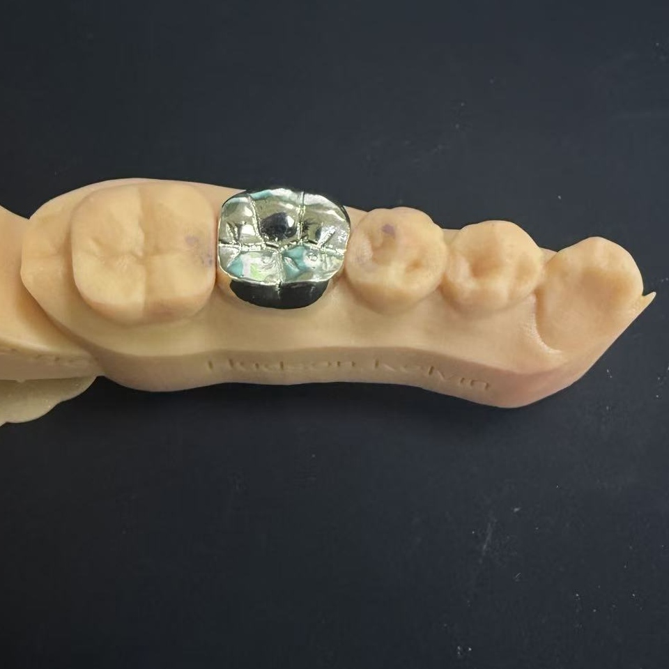 Златни круни: Изборот на скапоцениот метал за доживотна реставрација на забите