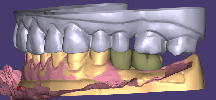 Естетското восок и привремените реставрации на WM Dental Lab освоија едногласно признание од клиентите