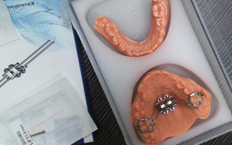 Разберете го MSE Skeletal Expansion со WM Dental Lab