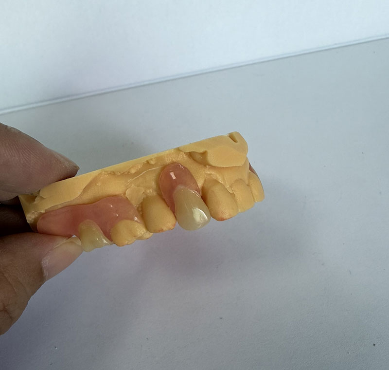 Valplast Парцијални во WM Dental Lab