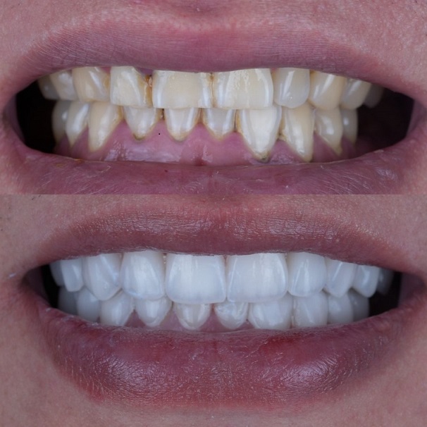 Emax Layered Veneers Esthetic China Dental Lab работа