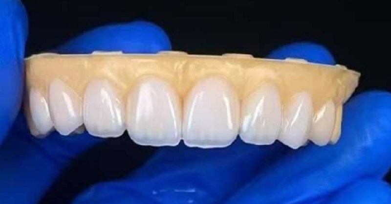dental veneers