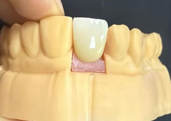 full crown restoration